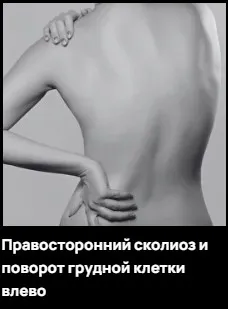 Правосторонний сколиоз и поворот грудной клетки влево (Александр Волоткевич)