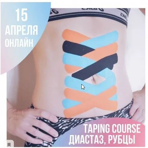 Диастаз, рубец, слабость пупочного кольца (грыжа). Тейпирование (Екатерина Невзорова / mavikatte)