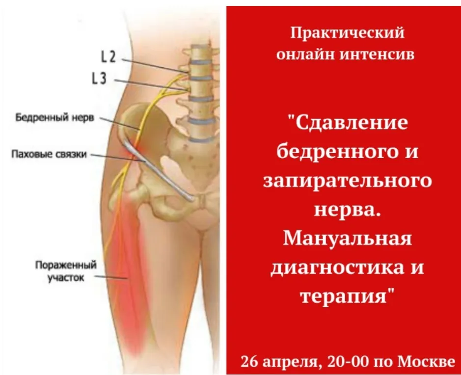 Сдавление бедренного и запирательного нерва (Игорь Атрощенко)