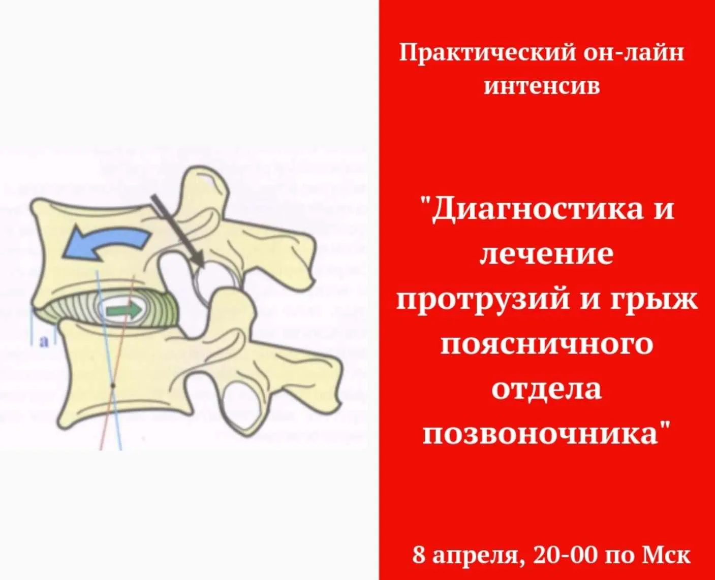 Диагностика и лечение грыж поясничного отдела (Игорь Атрощенко)