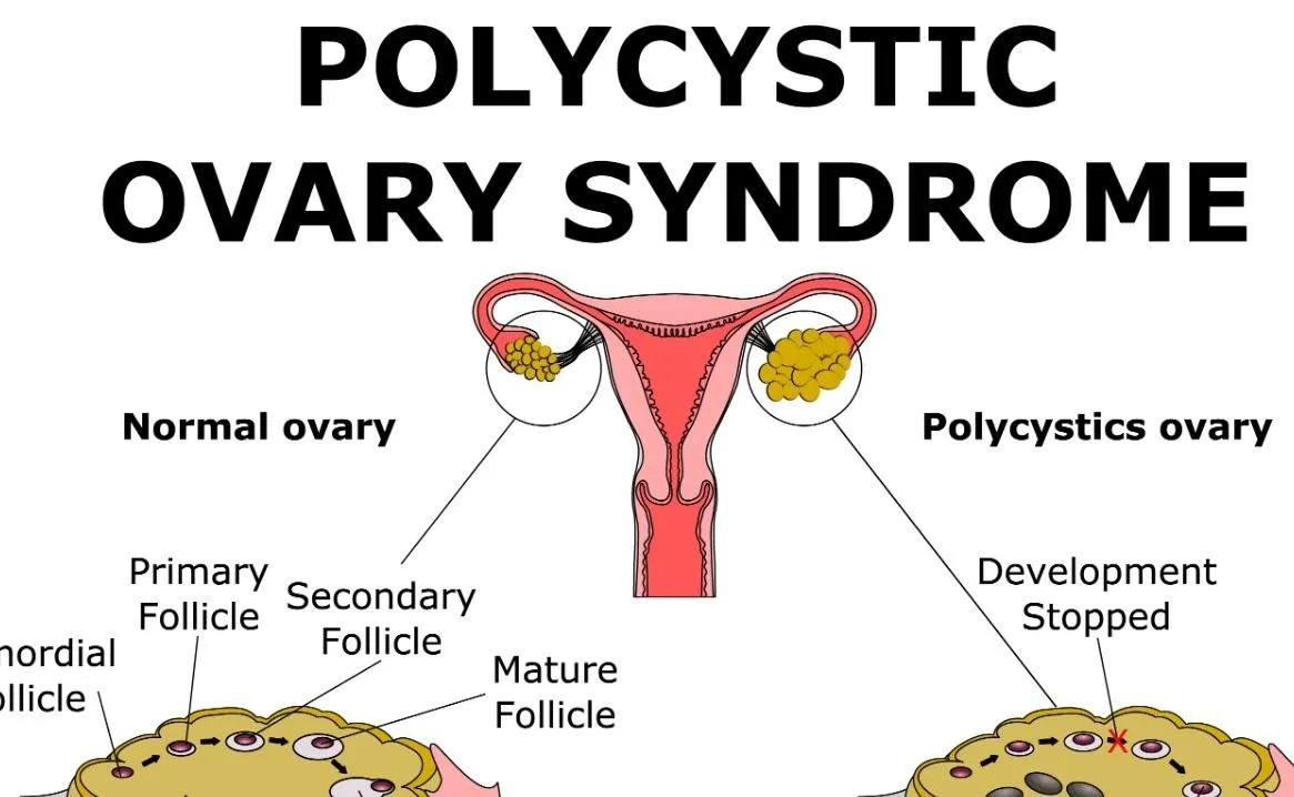 [Sigh Energy] Синдром поликистозных яичников Powerful Plus +11x (Extra Strong).  Polycystic ovary syndrome