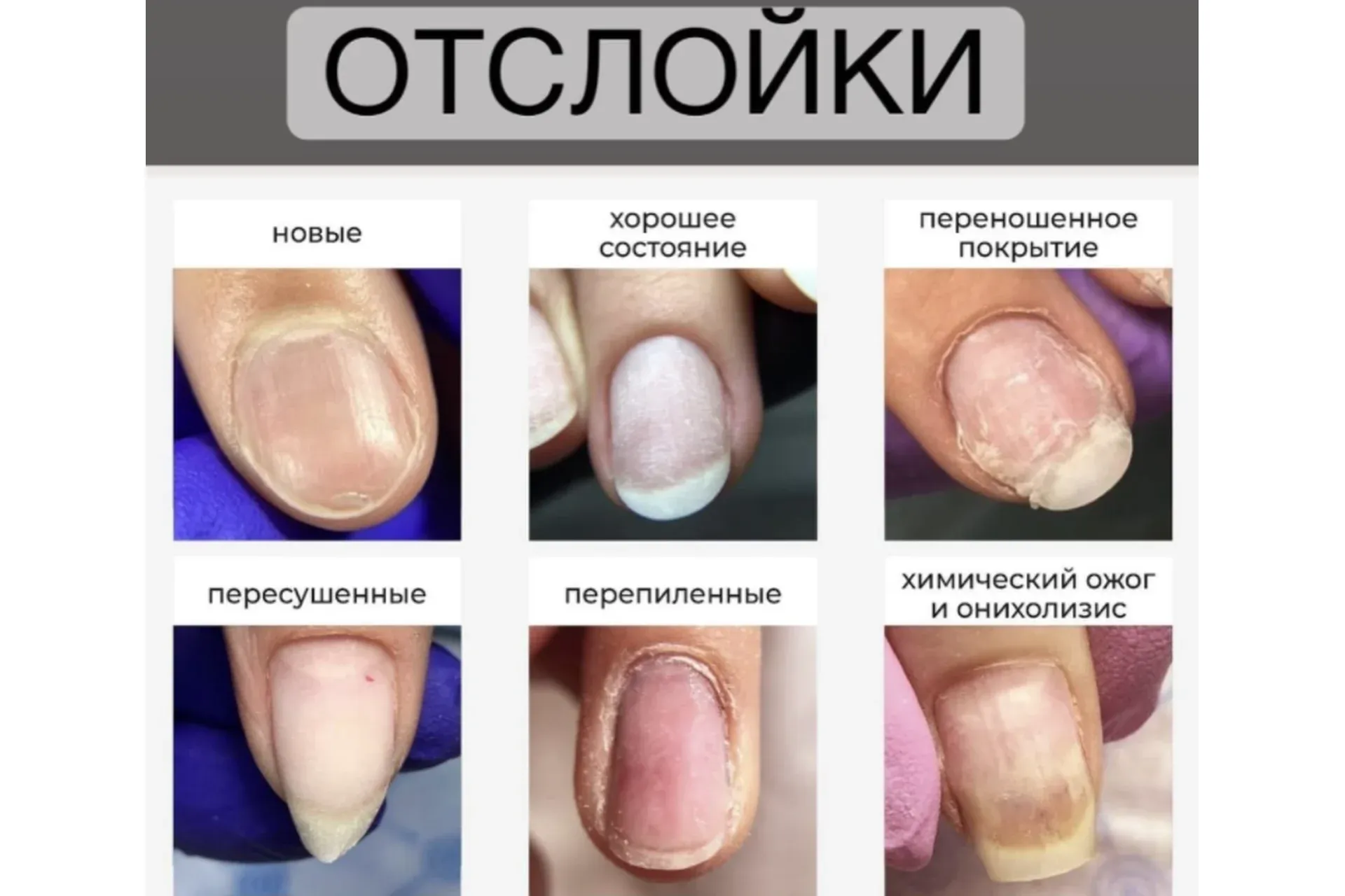 Отслойки (Вельмитина Зайцева)
