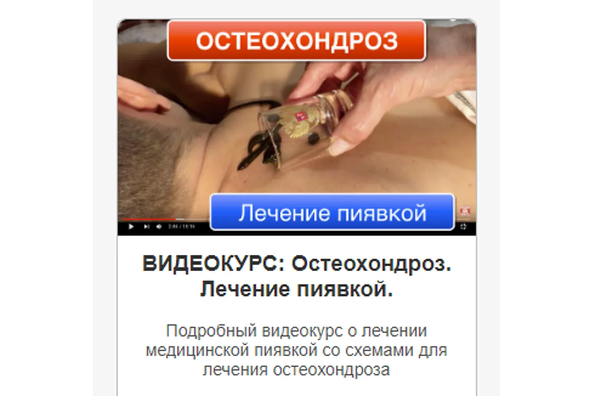 Остеохондроз. Лечение пиявкой (Светлана Кальсина)