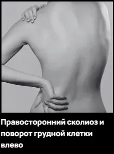 Правосторонний сколиоз и поворот грудной клетки влево (Александр Волоткевич)