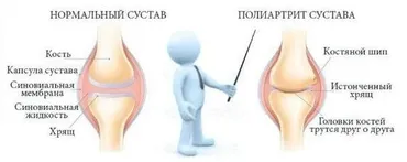 Реаматоидный полиартрит (Игорь Кауфман)