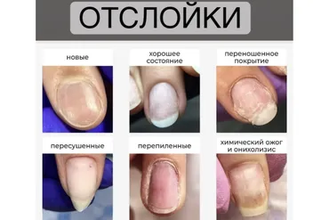 Отслойки (Вельмитина Зайцева)