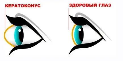 Убираем кератоконус. Возвращаем нормальную форму глаз (Людмила Лазарева)