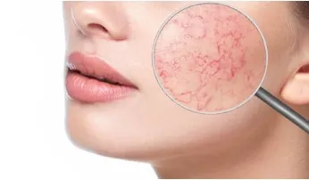 [Edcosmetology] Работа с кожей с куперозом (Анна Гордеева)