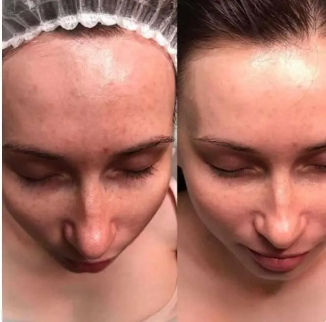 Молочный пилинг (natur.cosmetica)