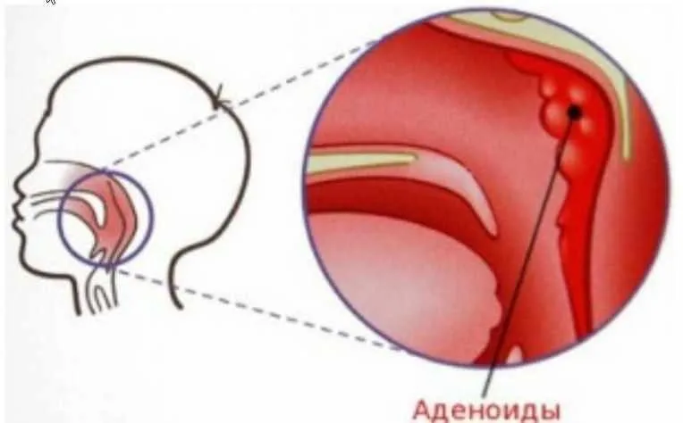 Аденоиды казнить нельзя помиловать (Елена Леднева)