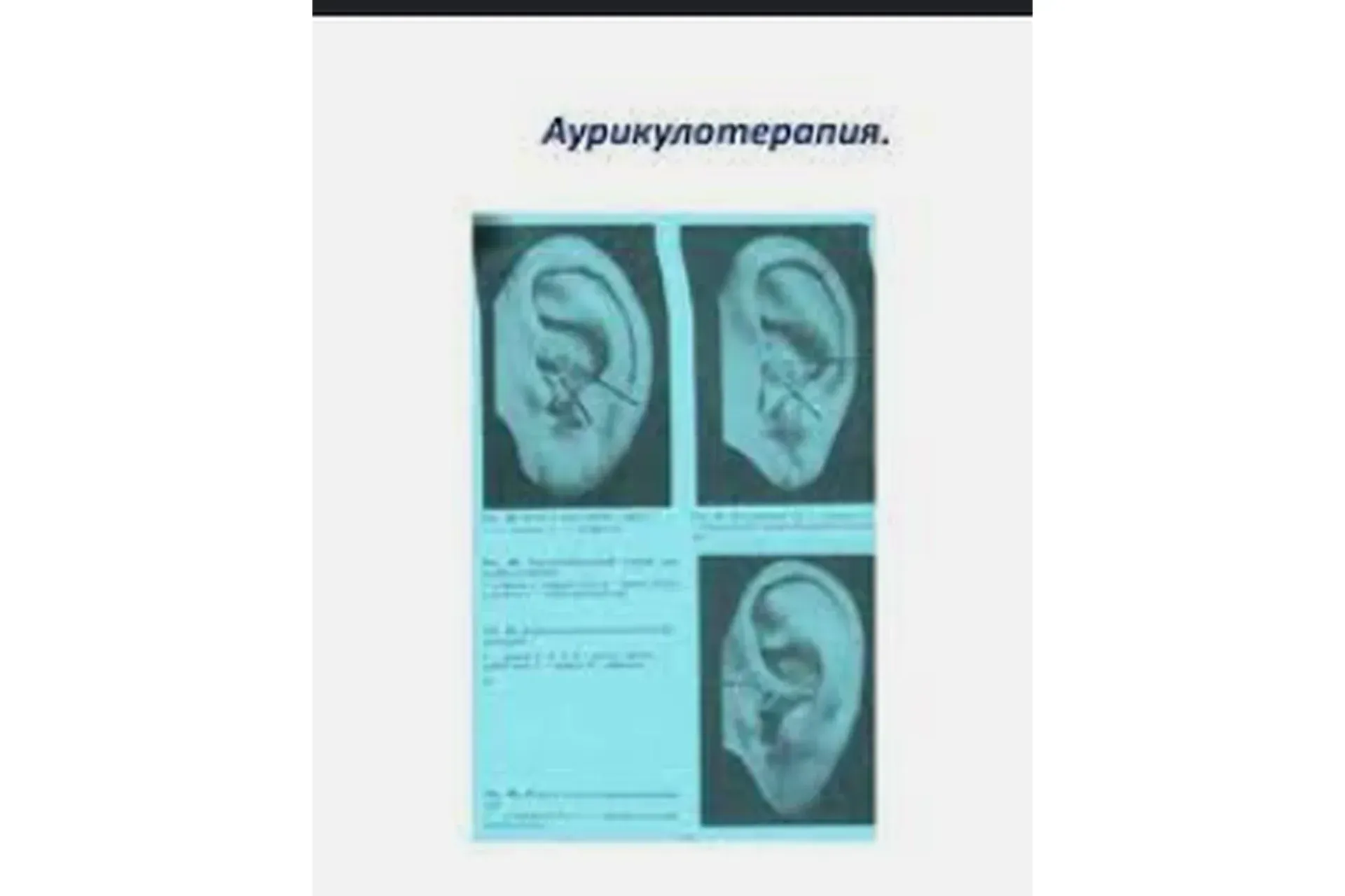 Клиническая аурикулотерапия (Елена Шведова)