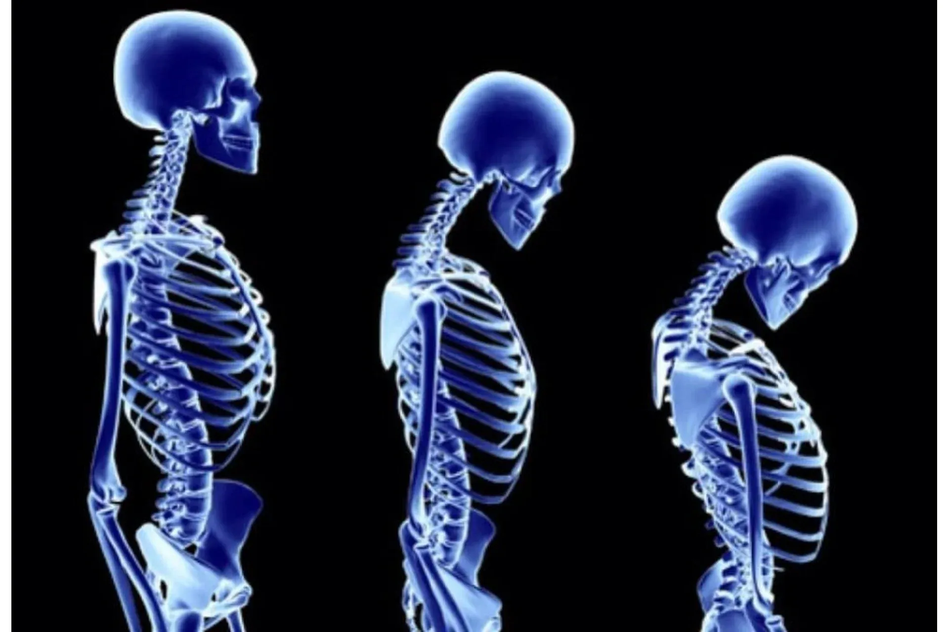[Wellcom] Кифоз 3D: Протоколы реабилитационных тренировок при гиперкифозе  (Эльмира Хабибуллина)